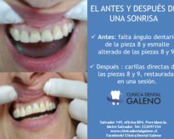 Trabajo destacado: carillas dentales