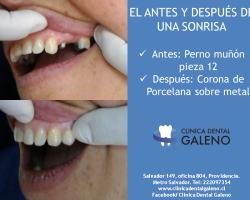 Trabajo destacado: Corona dental corona porcelana sobre metal pieza 12