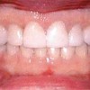 Bruxismo: Rechinar dientes en la noche los daña