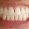BLANQUEAMIENTOS DENTALES PARA MEJORAR NUESTRA IMAGEN BLANQUEAMIENTO CON CUBETAS EFECTUADO EN 15 DIAS BAJO 4 TONOS Y LLEGO