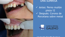 Corona dental pieza 12